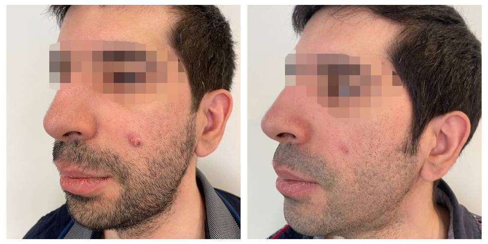 SkinDuo treatment before + after_1