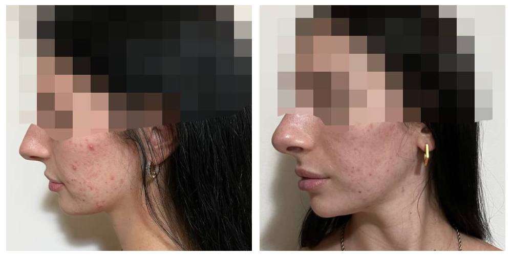 SkinDuo treatment before + after_10_v2