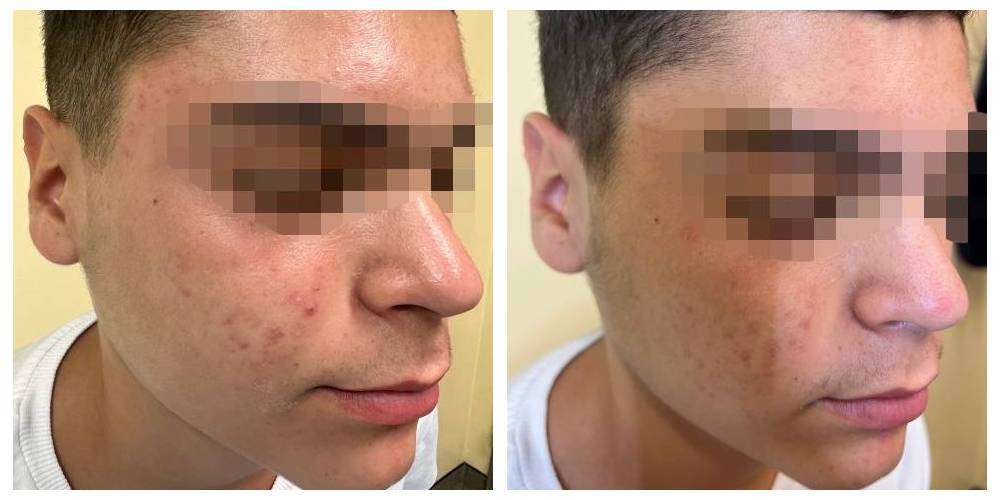 SkinDuo treatment before + after_13