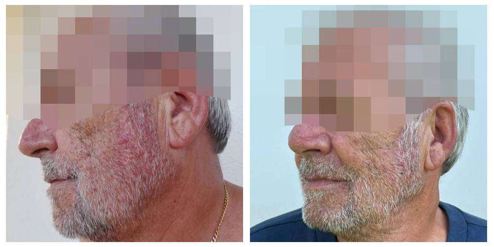 SkinDuo treatment before + after_15_v2