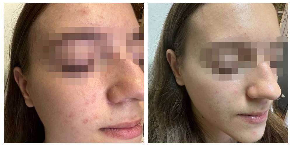 SkinDuo treatment before + after_16