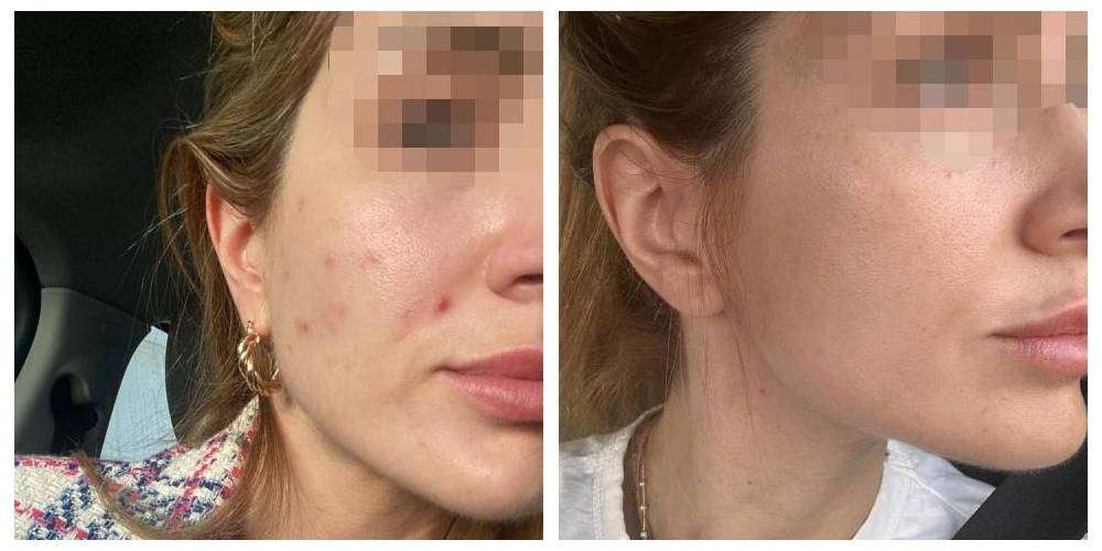 SkinDuo treatment before + after_17