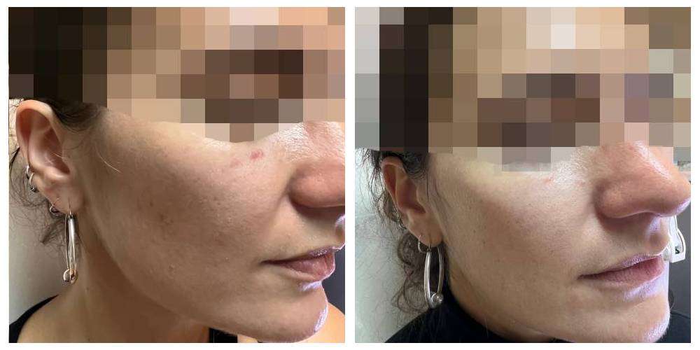 SkinDuo treatment before + after_18_v2