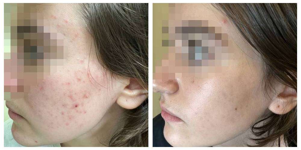 SkinDuo treatment before + after_4