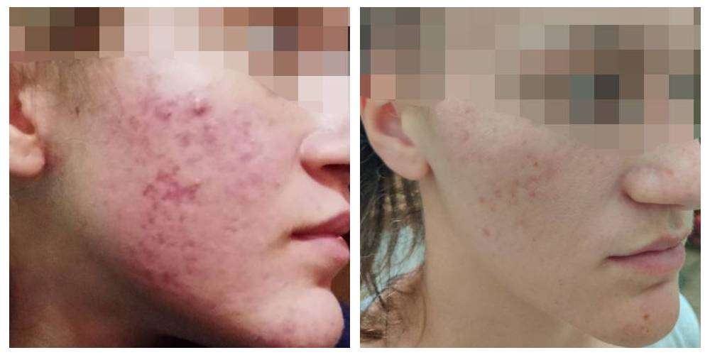 SkinDuo treatment before + after_5_v2